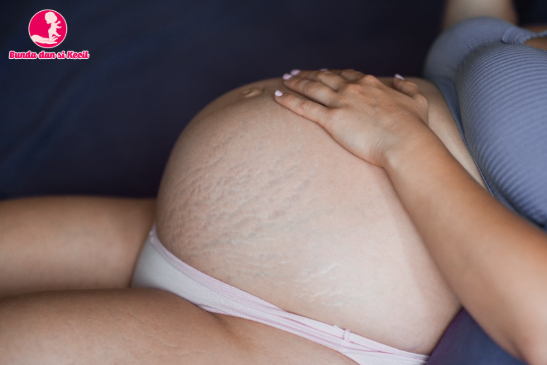 Stretch Marks Saat Hamil: Kenali Penyebab, Cara Merawat, dan Fakta Seputarnya, Bunda